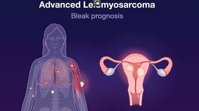 Doxorubicin–Trabectedin with Trabectedin Maintenance in Leiomyosarcoma